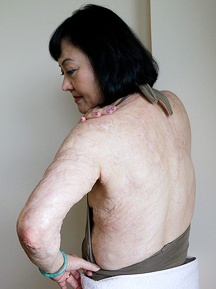 How the Vietnam War's 'Napalm Girl' Is Finally Getting Her Scars Treated  43 Years Later | Vietnam, Real People Stories